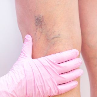 Prevenção de varizes